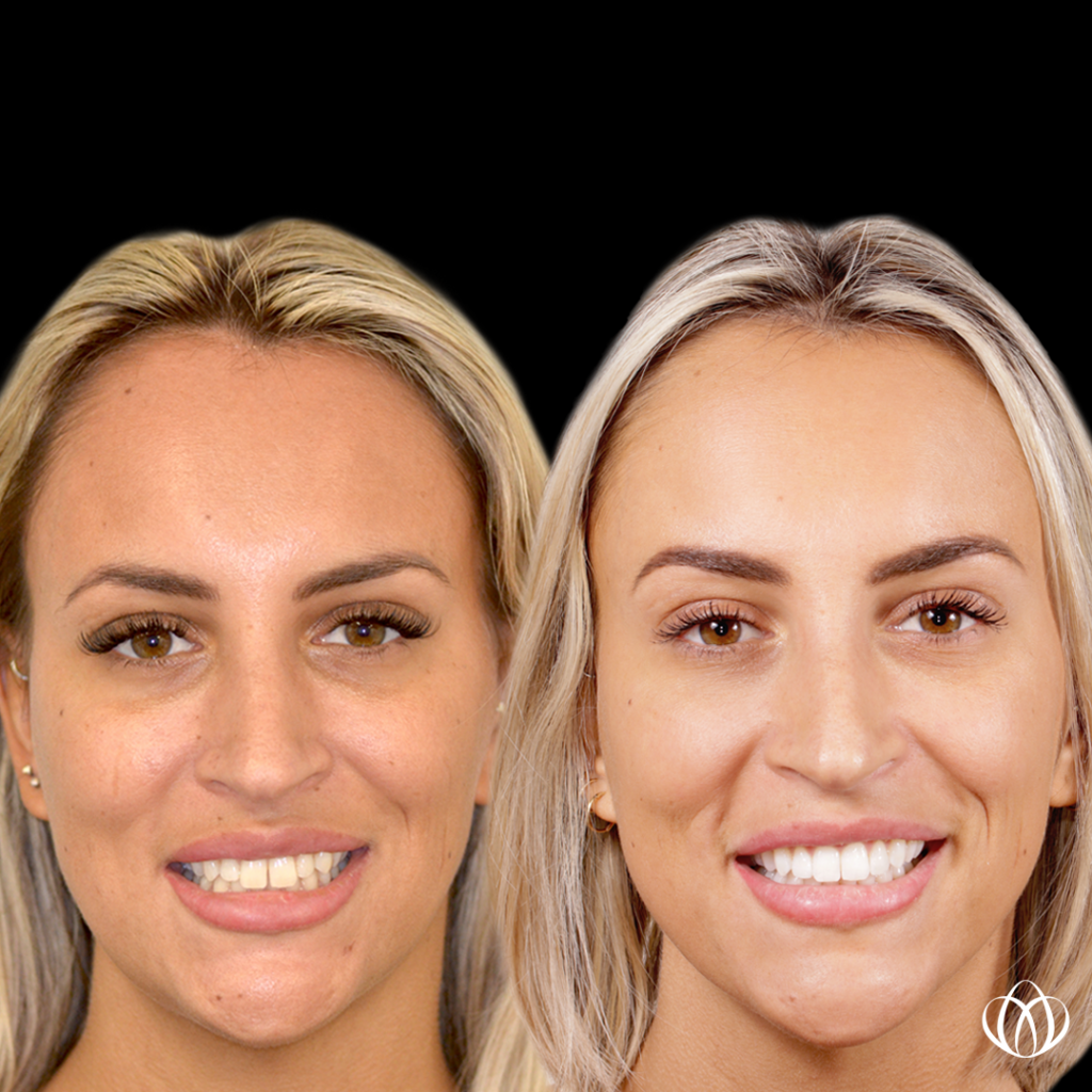 Before and after smile alignment clear teeth aligners